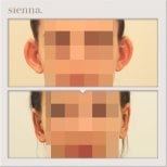 Before and after otoplasty results at Sienna Clinic, ear reshaping with natural appearance
