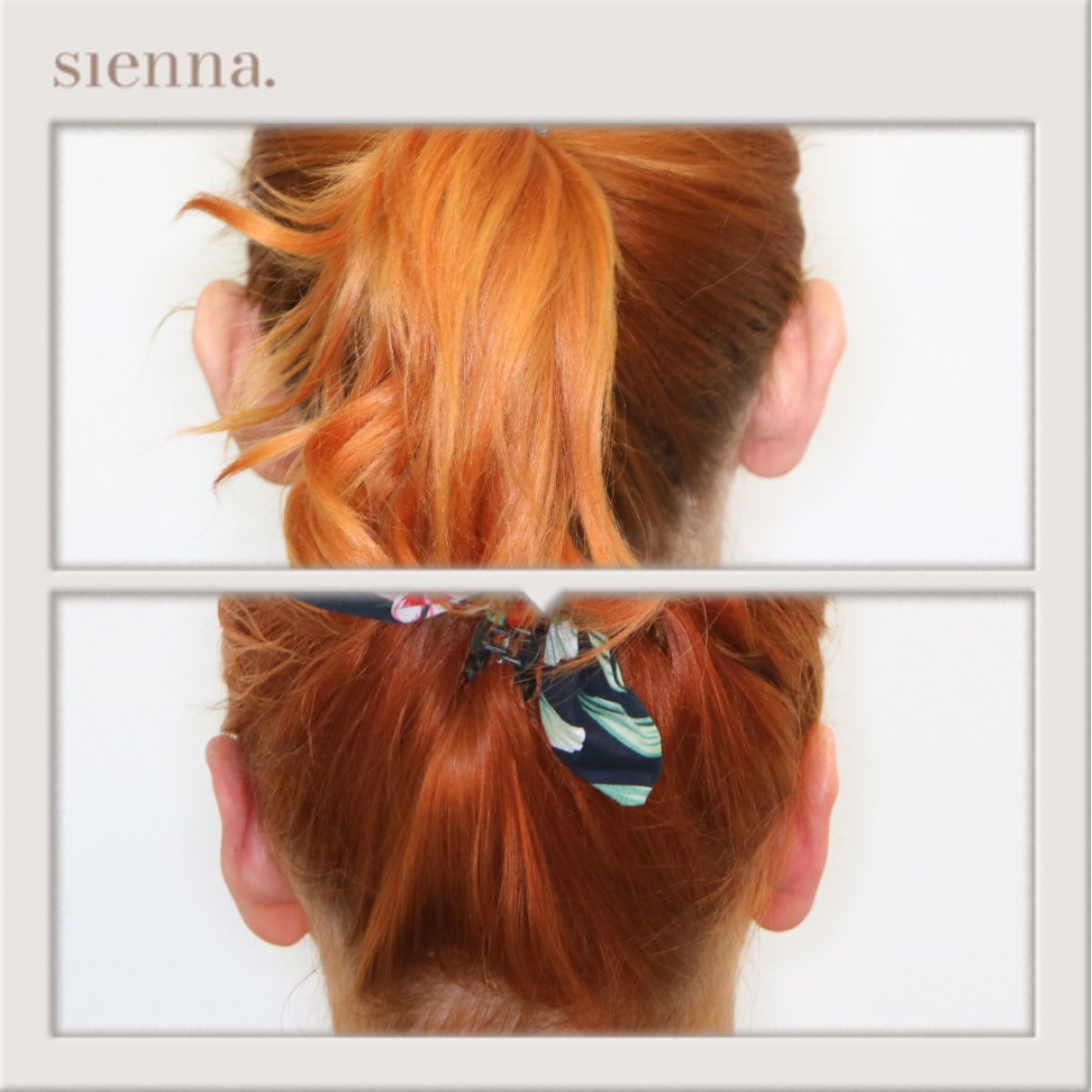 Resultados de otoplastia antes y después en Sienna Clinic, corrección de orejas natural