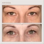 Before and after blepharoplasty results at Sienna Clinic, eyelid correction for refreshed look