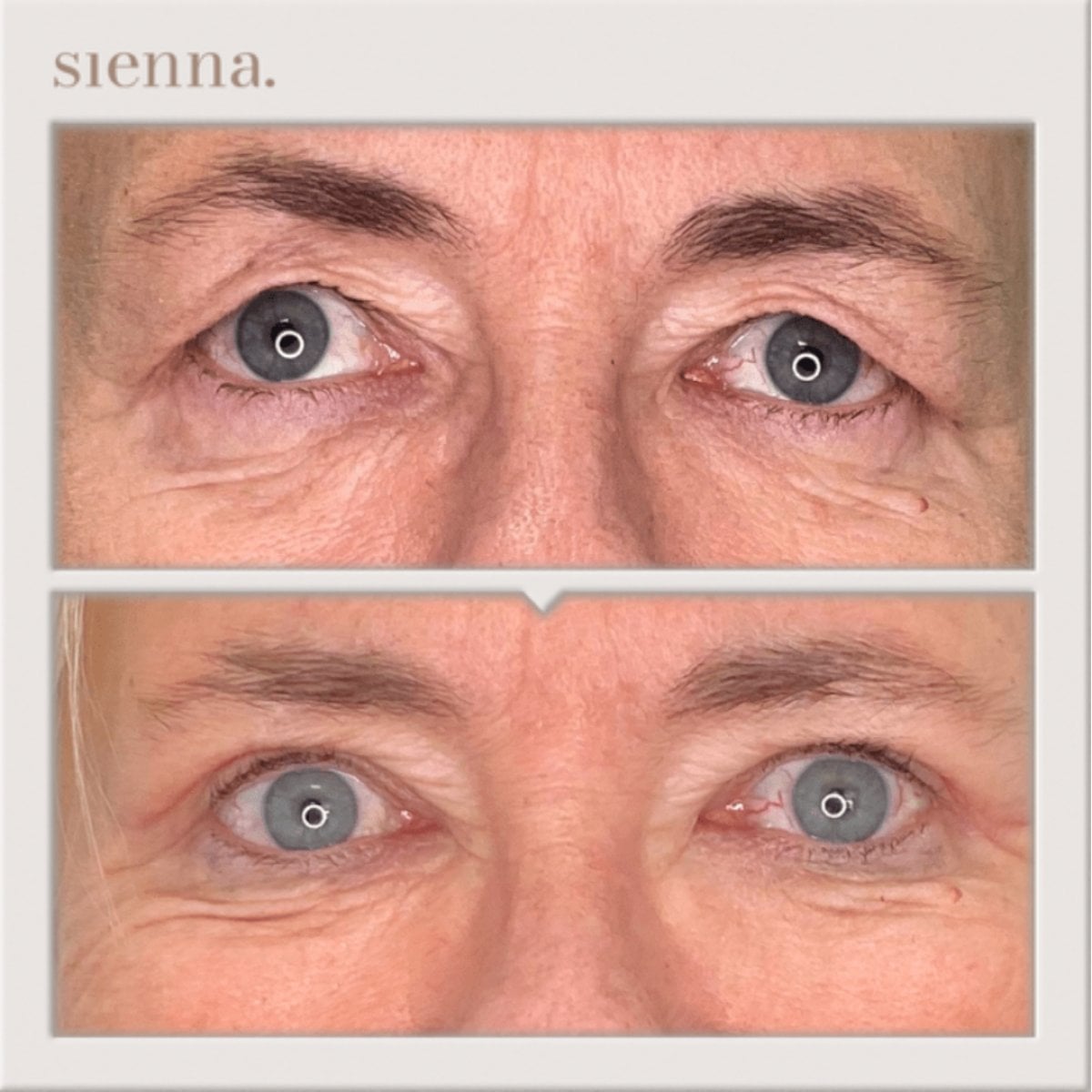 نتائج رأب الجفن قبل وبعد في Sienna Clinic – تصحيح الجفون لمظهر أكثر شبابًا