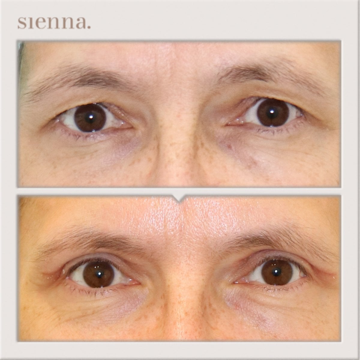 Resultados de blefaroplastia antes y después en Sienna Clinic, corrección de párpados