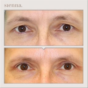 Before and after blepharoplasty results at Sienna Clinic, eyelid correction for refreshed look