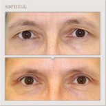 Before and after blepharoplasty results at Sienna Clinic, eyelid correction for refreshed look
