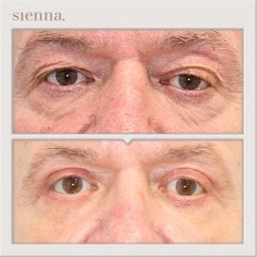 Before and after blepharoplasty results at Sienna Clinic, eyelid correction for rejuvenated look