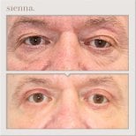 Before and after blepharoplasty results at Sienna Clinic, eyelid correction for rejuvenated look