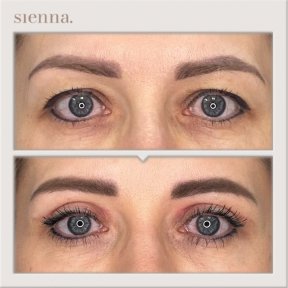 Before and after blepharoplasty results at Sienna Clinic, eyelid correction for youthful eyes