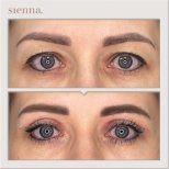 Before and after blepharoplasty results at Sienna Clinic, eyelid correction for youthful eyes