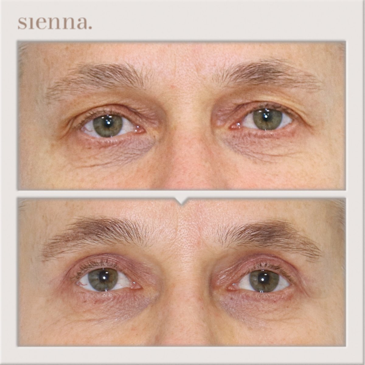 نتائج رأب الجفن قبل وبعد في Sienna Clinic، تصحيح الجفون للرجال