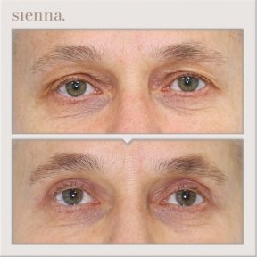 Before and after blepharoplasty results at Sienna Clinic, eyelid correction for men