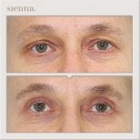 Before and after blepharoplasty results at Sienna Clinic, eyelid correction for men