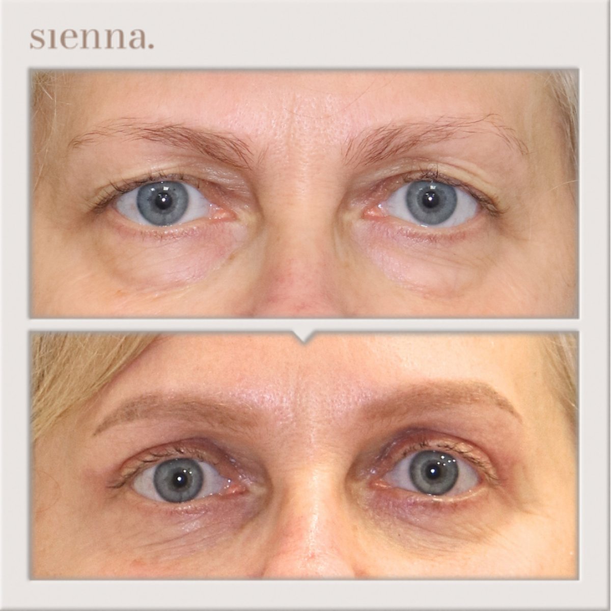 نتائج شد الجفون قبل وبعد في Sienna Clinic – تصحيح وتجديد الجفون