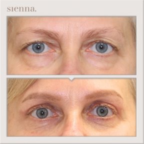 Before and after blepharoplasty results at Sienna Clinic – eyelid correction and rejuvenation