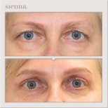 Before and after blepharoplasty results at Sienna Clinic – eyelid correction and rejuvenation