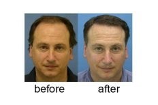 Before and after hair transplant results at ID Clinic Bangkok, restored fuller hairline