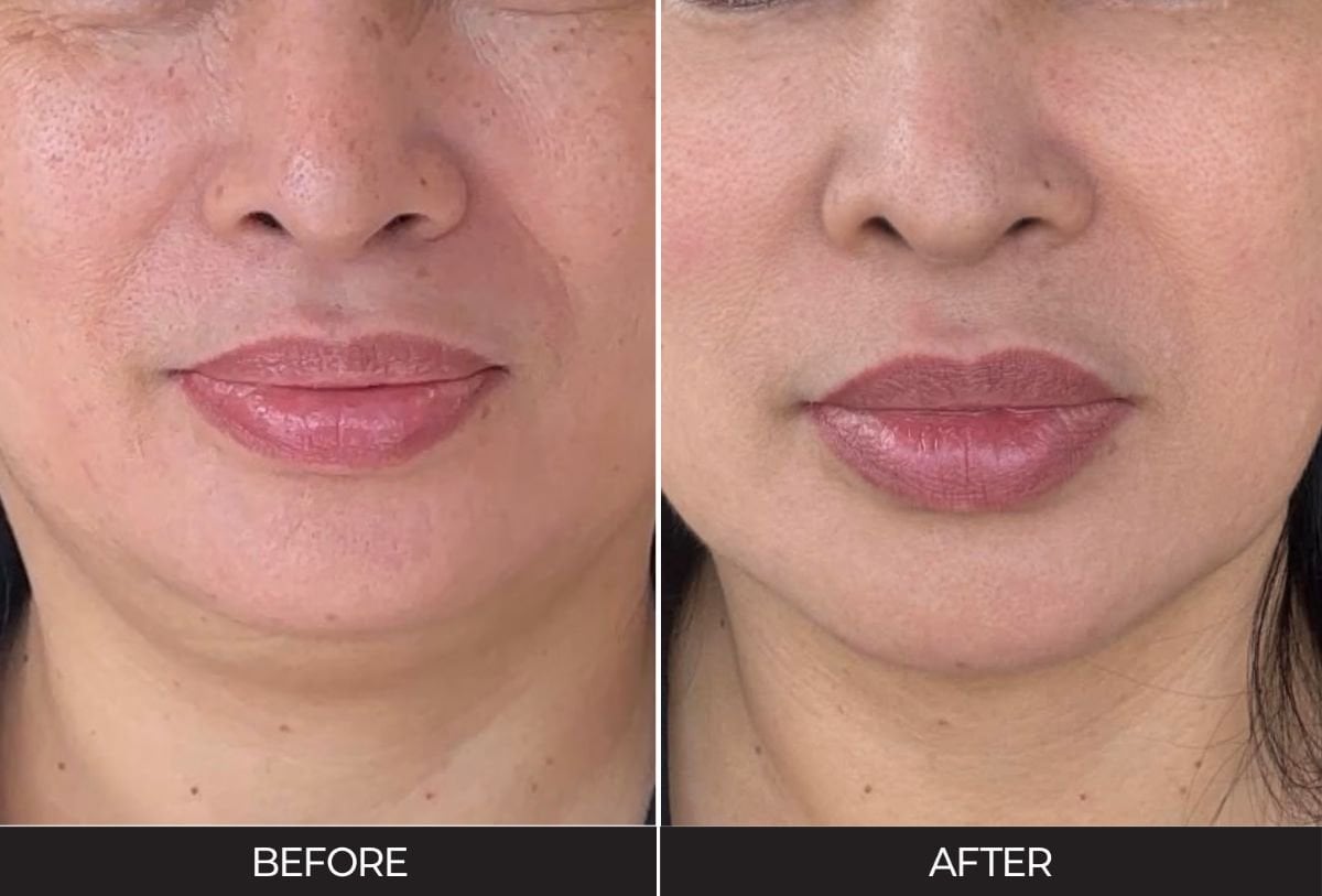 Resultado de terapia de rejuvenecimiento facial con células madre antes y después en Forena Clinic