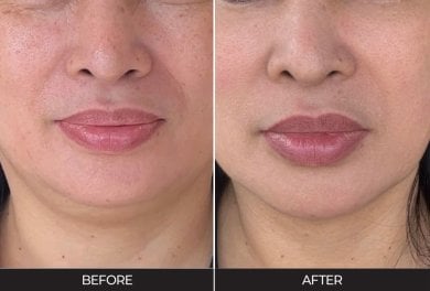 Before and after stem cell rejuvenation therapy result at Forena Clinic for facial anti-aging