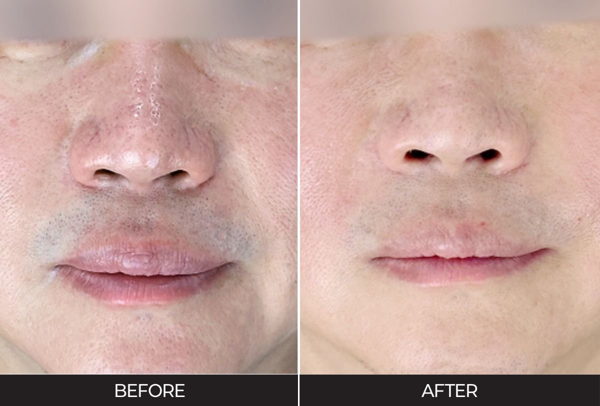 Resultados de Ultherapy antes y después en Forena Clinic: piel más firme y suave