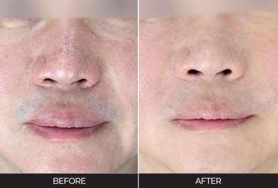 Ultherapy before and after results at Forena Clinic – improved skin firmness and smoothness