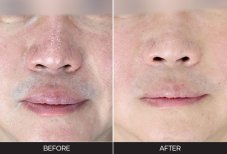 Ultherapy before and after results at Forena Clinic – improved skin firmness and smoothness