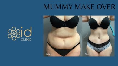 Before and after mummy makeover results at ID Clinic Bangkok, visible body contour improvement