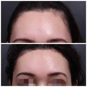 Результаты пересадки волос у женщин до и после в VG Plastic Surgery, восстановленная линия роста
