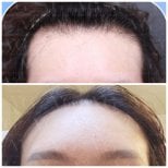 Результат пересадки волос у женщин до и после в VG Plastic Surgery, улучшенная линия роста