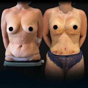 Before and after mommy makeover at Soraca Med – visible body contouring and skin tightening result