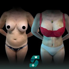 Before and after mommy makeover results at Soraca Med – body contour and breast enhancement