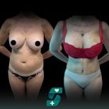 Before and after mommy makeover results at Soraca Med – body contour and breast enhancement