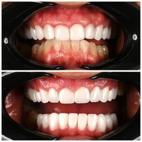Before and after dental implant results at Soraca Med – improved smile and whiter teeth