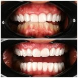 Before and after dental implant results at Soraca Med – improved smile and whiter teeth