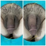 Resultados antes y después de relleno de pene en Eternity Clinic Pleonchit, mayor grosor