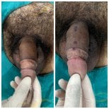 Before and after penis filler results at Eternity Clinic Phuket By Dr.Beer, visible enhancement