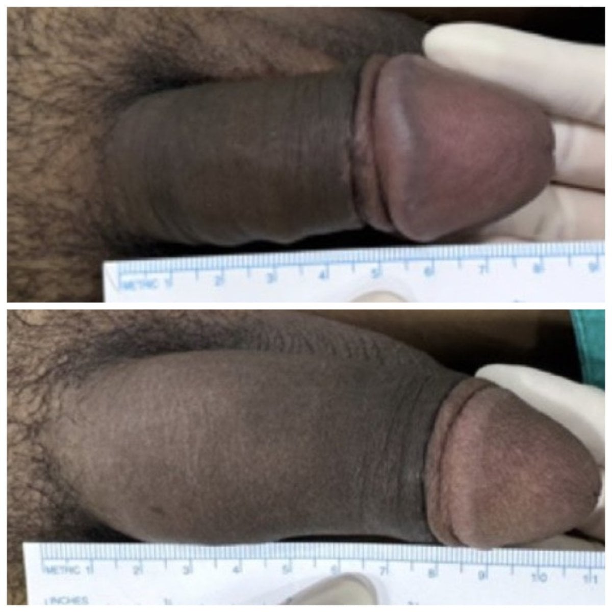 نتائج قبل وبعد حقن الفيلر للعضو الذكري في Eternity Clinic Phuket By Dr.Beer، تحسين ملحوظ