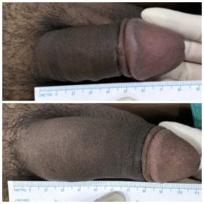 Resultados antes y después de relleno de pene en Eternity Clinic Phuket By Dr.Beer, mejora visible