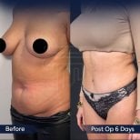 Vorher-nachher-Ergebnis Bauchdeckenstraffung und Fettabsaugung bei Dr. Safa Manav Clinic