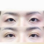 Upper eyelid surgery before and after results at Asia Cosmetic Hospital, improved eye contour