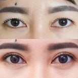 Before and after upper eyelid surgery results at Asia Cosmetic Hospital, improved eye contour