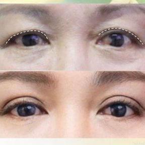 Before and after upper eyelid surgery results at Asia Cosmetic Hospital, rejuvenated eye area