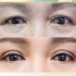 Before and after upper eyelid surgery results at Asia Cosmetic Hospital, rejuvenated eye area