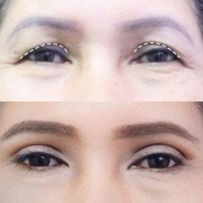 Before and after upper eyelid surgery results at Asia Cosmetic Hospital, rejuvenated eye area