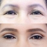 Before and after upper eyelid surgery results at Asia Cosmetic Hospital, rejuvenated eye area