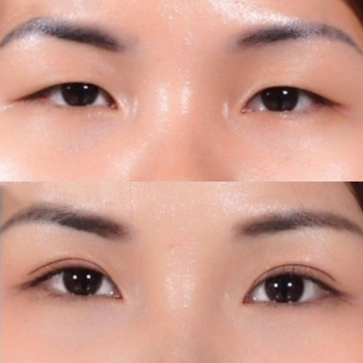 نتائج عملية الجفن العلوي قبل وبعد في Asia Cosmetic Hospital، تحسين شكل العين