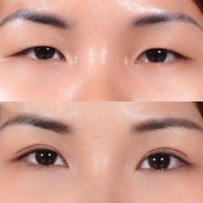 Before and after upper eyelid surgery results at Asia Cosmetic Hospital, improved eye contour