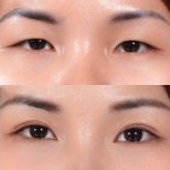 Before and after upper eyelid surgery results at Asia Cosmetic Hospital, improved eye contour