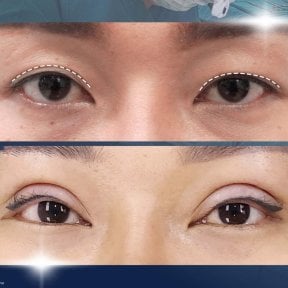 Before and after upper eyelid surgery results at Asia Cosmetic Hospital, improved eyelid contour