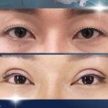 Before and after upper eyelid surgery results at Asia Cosmetic Hospital, improved eyelid contour