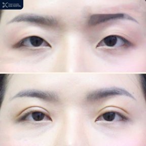 Before and after upper eyelid surgery results at Asia Cosmetic Hospital, improved eye contour