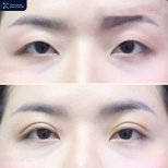 Before and after upper eyelid surgery results at Asia Cosmetic Hospital, improved eye contour