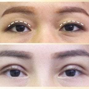 Before and after upper eyelid surgery results at Asia Cosmetic Hospital, eyelid lift improvement